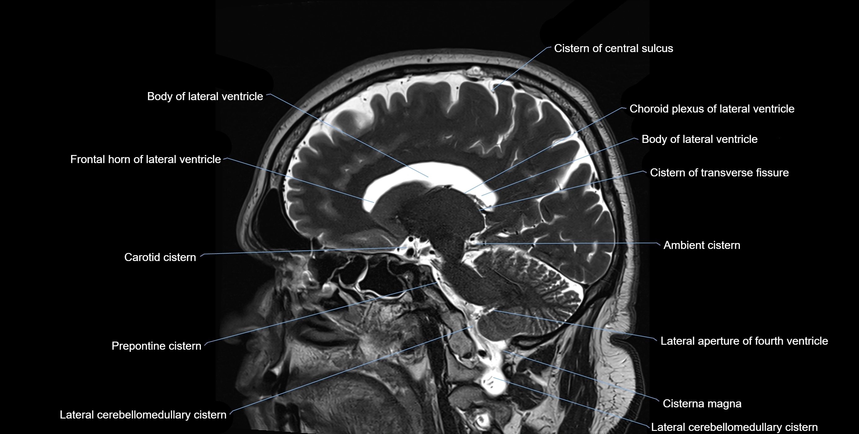 Brain cisterns  and ventricles sagittal anatomy 3T MRI image-img-00001-00035.webp